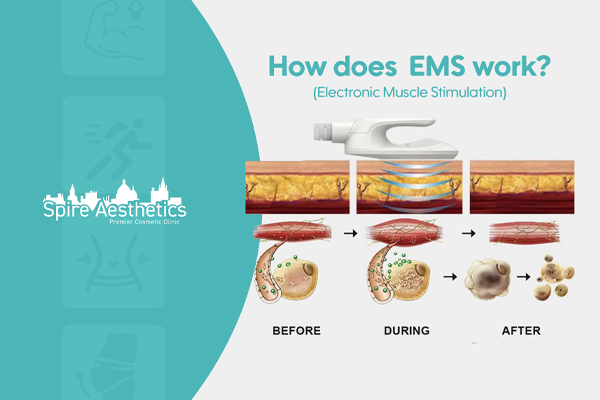 EMS treatment for post pregnancy weight loss treatment Newark