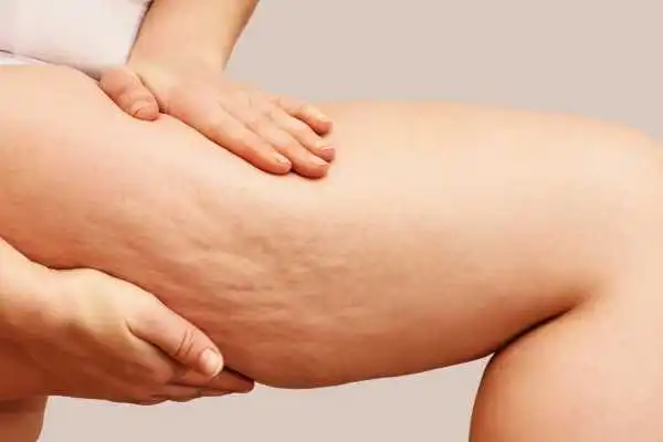 Image of woman showing leg with cellulite Newark