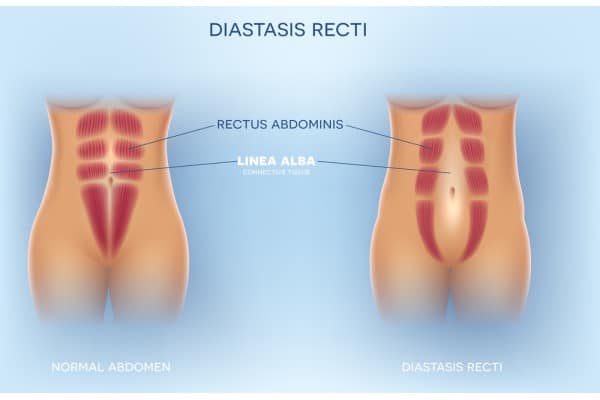 What Non-Surgical Options Are Available for Diastasis Recti Newark?