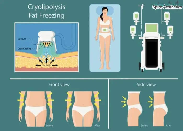 Fat freezing treatment Newark benefits for competitions to remove stubborn fat deposits.