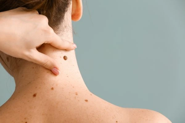 skin blemish removal Newark treatment